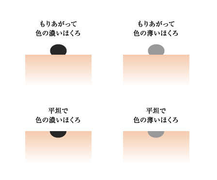 ほくろの種類